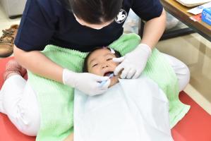 歯ブラシでフッ化物塗布をする様子