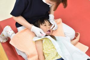 歯ブラシでフッ化物塗布をする様子